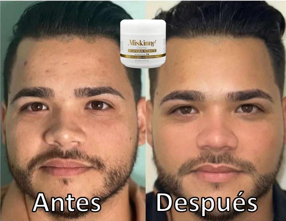 Crema Despigmentante Miskinne
