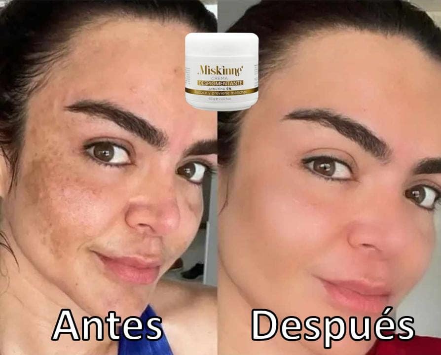 Crema Despigmentante Miskinne